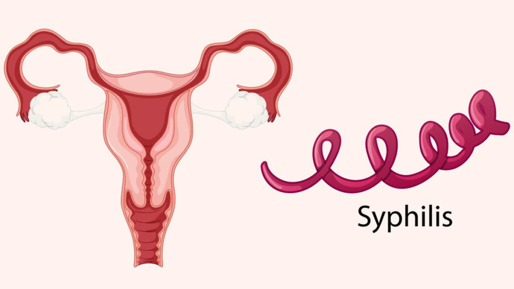 Syphilis in women