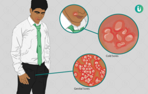 Herpes Simplex Virus (HSV) in Men