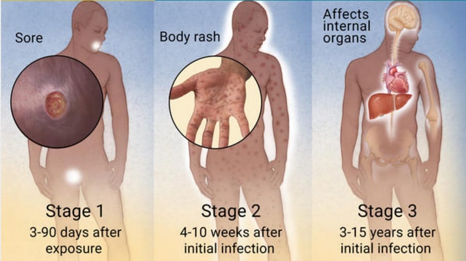 syphilis symptoms in men